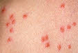 Human Flea Bites